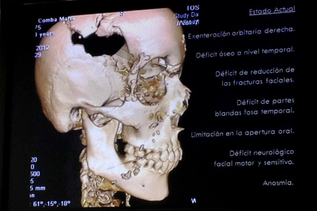 Radiografía del cráneo de María tras una de sus operaciones